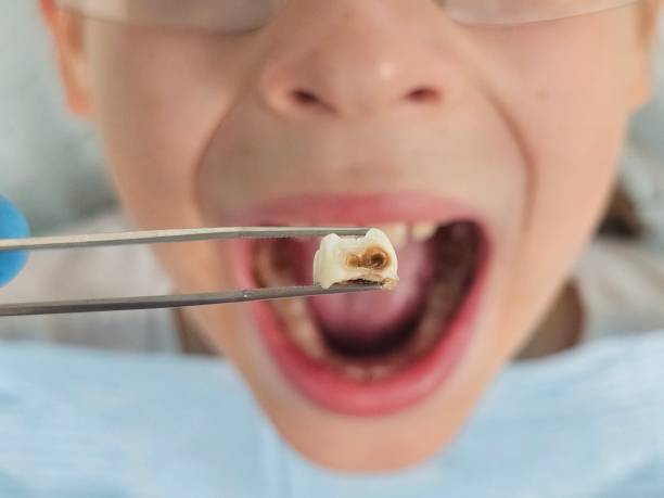 Best Knocked-Out Tooth Emergency  in Weston Lakes, TX